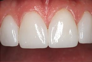 Alpine Dentistry | Dental Bridges, Fluoride Treatment and Digital Radiography