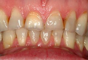 Alpine Dentistry | Cosmetic Dentistry, Empress   Restorations and Ceramic Crowns