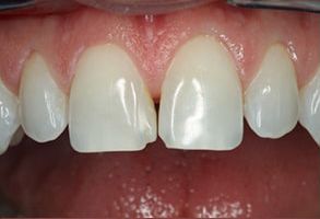 Alpine Dentistry | Root Canals, Inlays  amp  Onlays and Crowns  amp  Caps